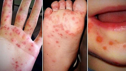 Hà Nội ghi nhận 313 trường hợp mắc tay chân miệng trong tuần qua