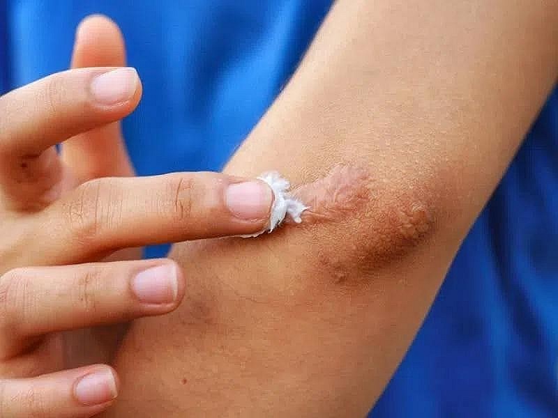 Thu hồi, tiêu huỷ 1 loại gel 'ngừa sẹo' do vi phạm 3 lỗi