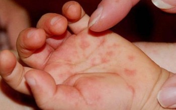 Hơn 25.000 ca mắc tay chân miệng, tăng gấp 5 lần so với cùng kỳ
