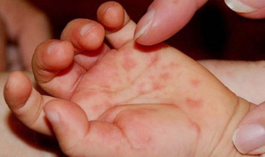Hơn 25.000 ca mắc tay chân miệng, tăng gấp 5 lần so với cùng kỳ Hơn 25.000 ca mắc tay chân miệng, tăng gấp 5 lần so với cùng kỳ