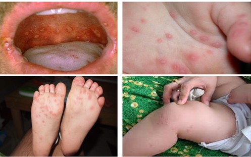 Bệnh tay chân miệng gia tăng, Bộ Y tế yêu cầu chủ động kiểm soát lây nhiễm