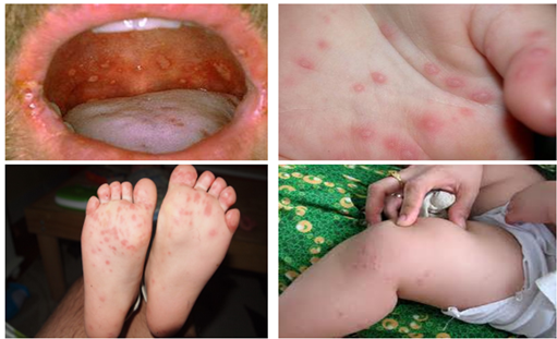 Bệnh tay chân miệng gia tăng, Bộ Y tế yêu cầu chủ động kiểm soát lây nhiễm Bệnh tay chân miệng gia tăng, Bộ Y tế yêu cầu chủ động kiểm soát lây nhiễm