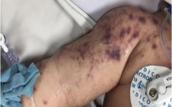 Có 4 ca tử vong do não mô cầu, Bộ Y tế khuyến cáo phòng bệnh