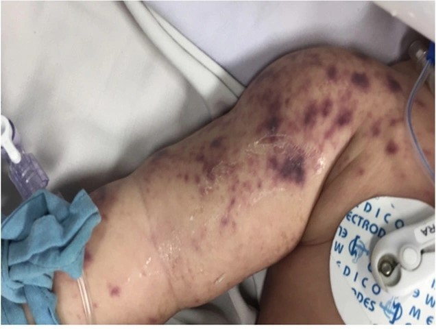 Có 4 ca tử vong do não mô cầu, Bộ Y tế khuyến cáo phòng bệnh