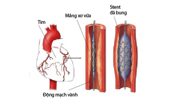 Khuyến cáo mới về phẫu thuật nong mạch vành